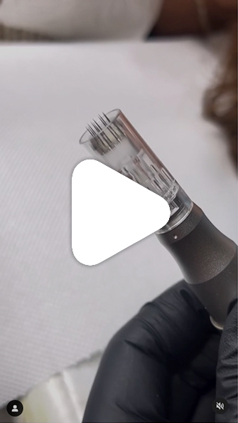 A microneedling treatment including tools used and different angles A microneedling treatment including tools used and different angles