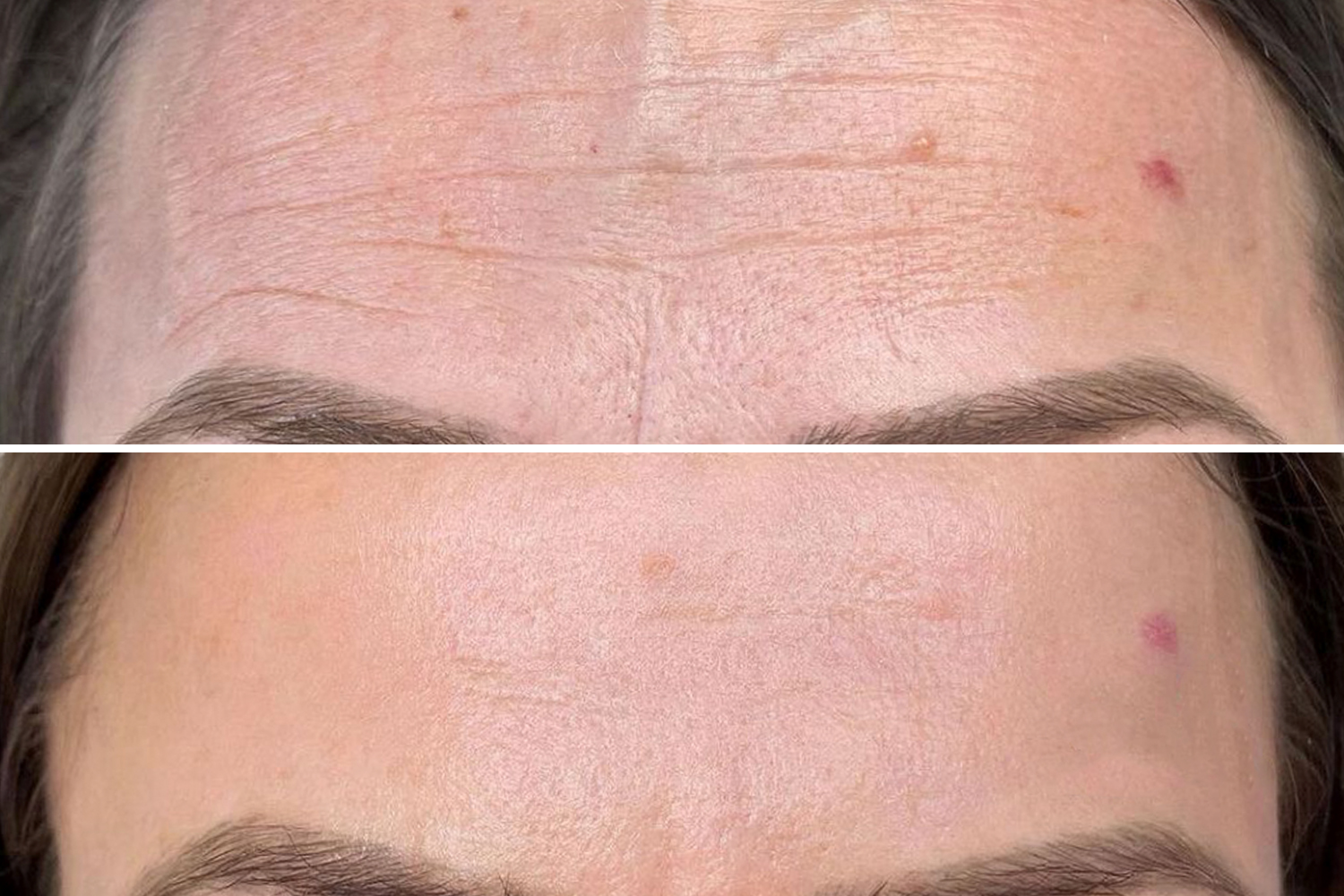 PhiIon-Technikerin - Svitlana Bidzilia führt eine Microneedling-Behandlung durch. PhiIon-Technikerin - Svitlana Bidzilia führt eine Microneedling-Behandlung durch.