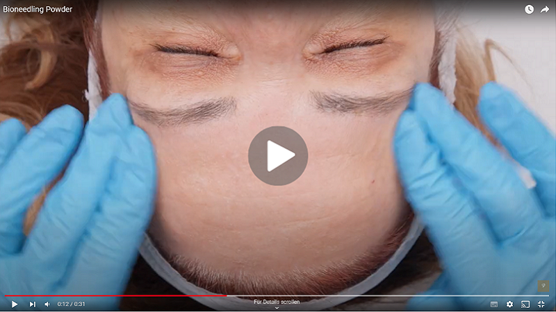 Schritt-für-Schritt-Video zur Bioneedling-Behandlung Schritt-für-Schritt-Video zur Bioneedling-Behandlung